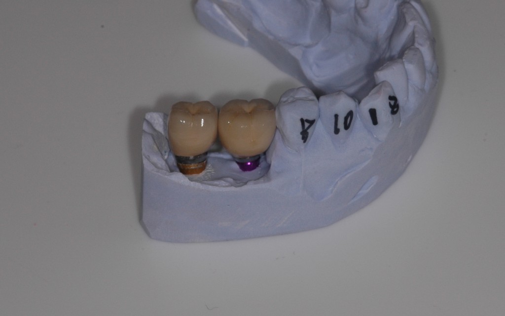 cement retained dental implant crowns