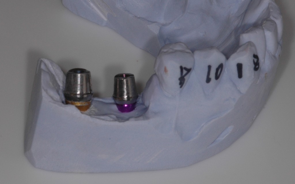 implant abutments in place