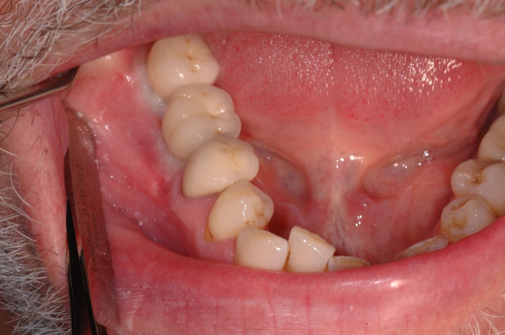 cement retained crowns