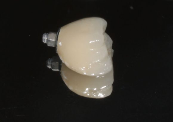 Screw retained molar dental implant crown prior to fitting in patients mouth