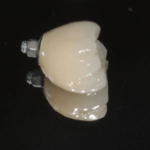 Screw retained molar dental implant crown prior to fitting in patients mouth